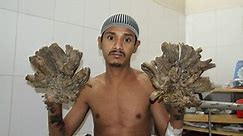 'Tree man' gets his hands back