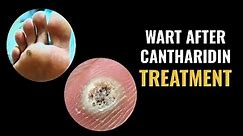 Wart After Cantharidin Treatment