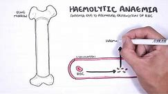 Haemolytic Anaemia - classification (intravascular, extravascular), pathophysiology, investigations