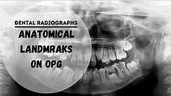 Dental panoramic radiographs | OPG | DPT Anatomical Landmarks