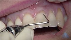 C1-8 AlloDerm Grafting of Multiple Maxillary Teeth with Root Notching
