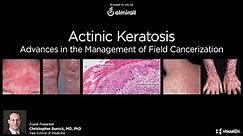 Actinic Keratosis: Advances in the Management of Field Cancerization