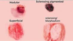 Basal Cell Carcinoma (epithelioma) animation