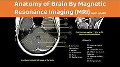 Brain Anatomy On an MRI (Magnetic Resonance Imaging) Scan