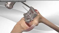 Endoproteza całkowita stawu kolanowego - animacja 3D z wyjaśnieniem