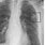 4Mm Lung Nodule
