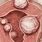 5 Cm Fibroid in Uterine