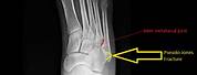 5th Metatarsal Fracture Radiology