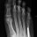 5th Metatarsal Fracture Treatment