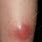 Abscess On Leg