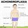 Achondroplasia Features