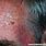 Age Spots On Forehead