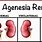 Agenesia Renal Bilateral