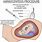 Amniocentesis Process