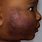 Atopic Dermatitis Dark Skin