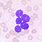 B-cell Acute Lymphoblastic Leukemia