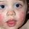 Baby Skin Rash On Face