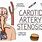 Bilateral Carotid Artery Stenosis
