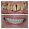 Bone Loss Dentures
