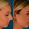 Bulbous Rhinoplasty Before and After