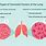 Carcinoid Tumor