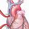 Cardiac Bypass Cannulation