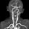 Carotid Artery CT Scan