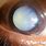Cataract Fundoscopy