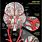 Cerebral Artery Aneurysm