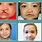 Cleft Palate Treatment