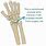 Common Wrist Fractures