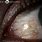 Conjunctival Lymphangiectasia