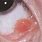 Conjunctival Squamous Papilloma
