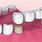Dental Bridges Back Teeth
