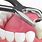 Dental Extraction Images