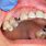 Dental Implant Post