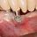 Dental Implants with Bone Loss