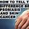 Eczema vs Skin Cancer