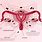 Endometriosis On Ovary