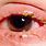 Eye Infection Blepharitis