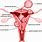 Fibroid On Cervix
