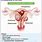 Fibroids Leiomyomas