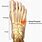 Fifth Metatarsal Stress Fracture