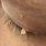 Filiform Warts On Eyelids