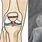 Fracture Patella Broken Knee