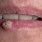HPV Inside Lip
