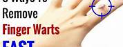 How to Get Rid of Warts On Fingers Fast