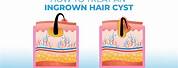 Ingrown Hair Cyst Treatment