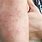 Itchy Skin Eczema