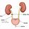 Kidney Stone Path Diagram